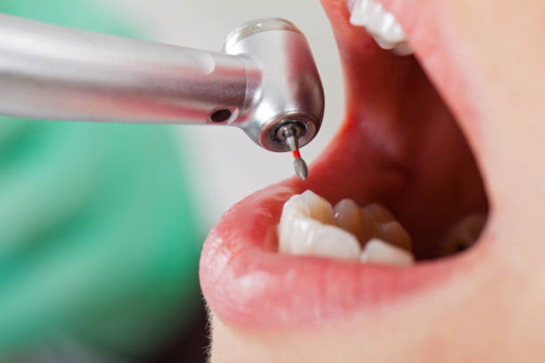 Best Emergency Wisdom Teeth Removal in Anson, TX